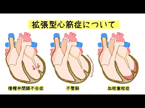 拡張型心筋症について詳しく解説