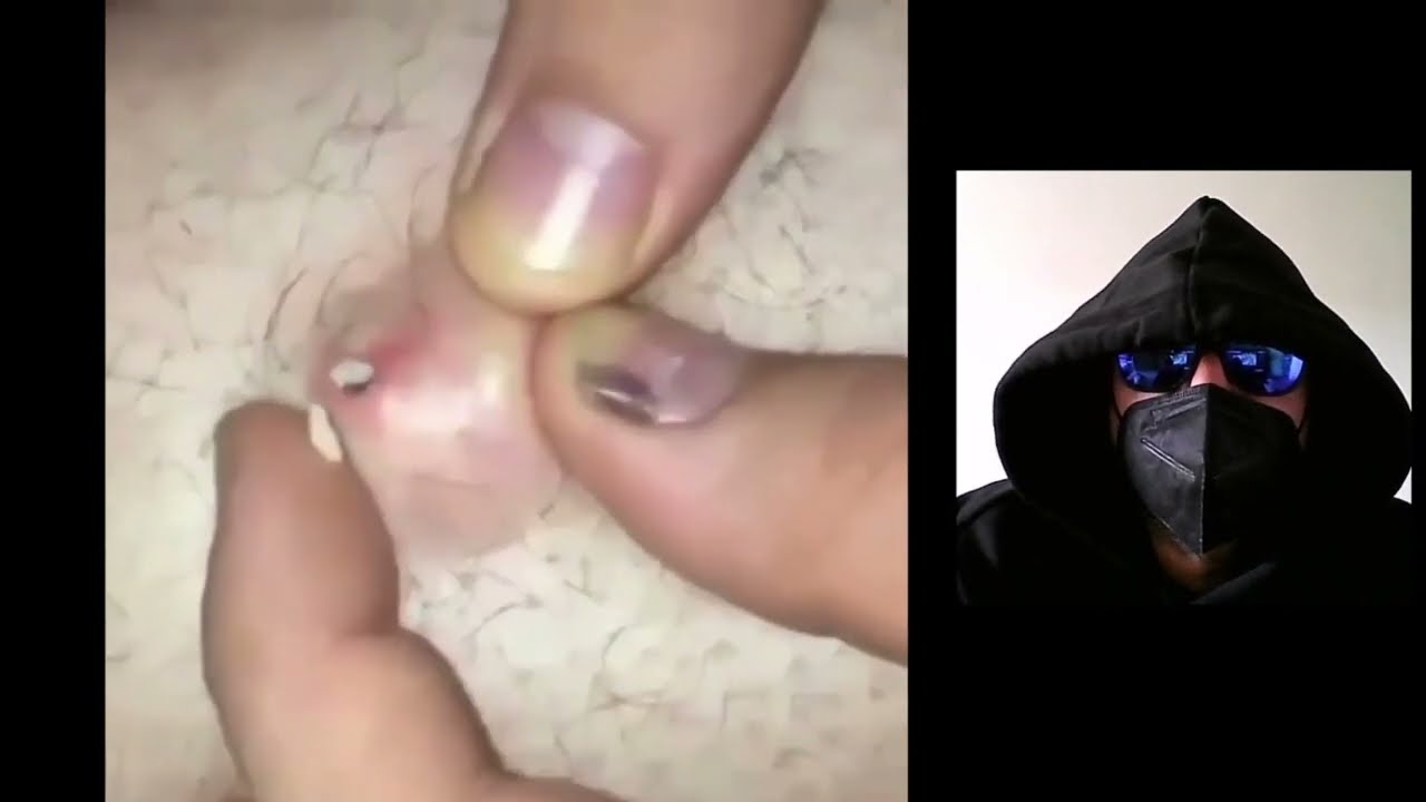 grano pringoso con PUS espeso y pegajoso #1