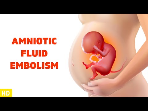 Amniotic Fluid Embolism: The Silent Threat During Childbirth
