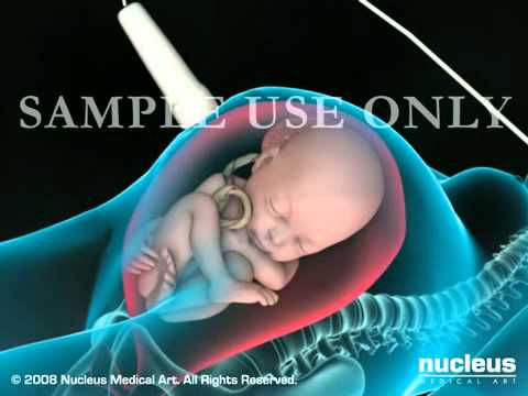 Lower Segment Caesarean Section  Цезарово Сечение