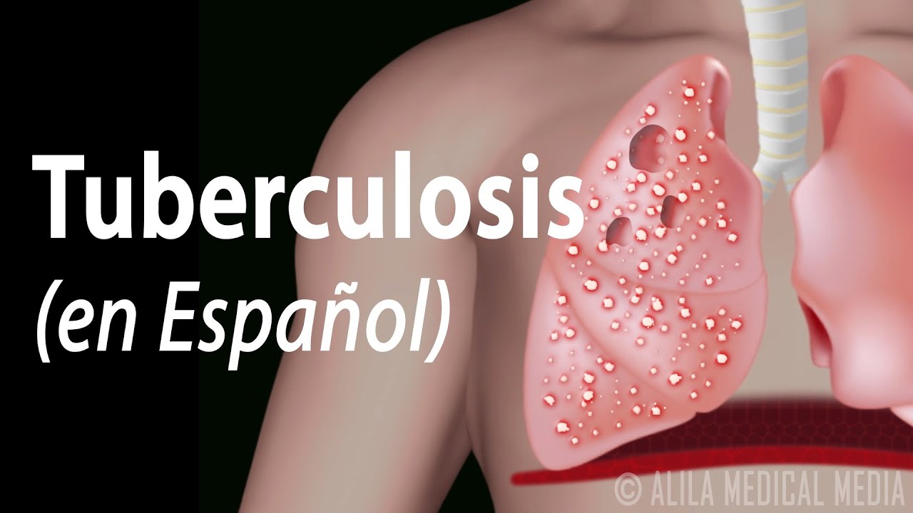 Tuberculosis: Progresión de la Enfermedad, Animación. Alila Medical Media Español.