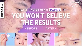 Clear Skin Remedies to Remove Acne Scars and Dark Spots | Product Recommendations and Skincare Tips