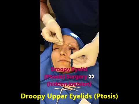 Droopy Upper Eyelids (Ptosis) Surgery Droopy Upper Eyelids (Ptosis) Surgery