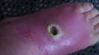 Spider Bite Wound After Three Months-Caution-Disturbing To Watch