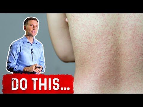 The 3 Top Allergies on the Planet