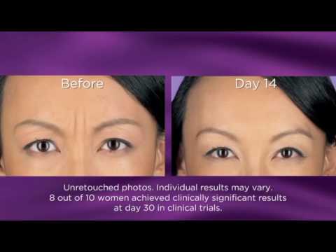 BOTOX Cosmetic for fine-lines and wrinkles
