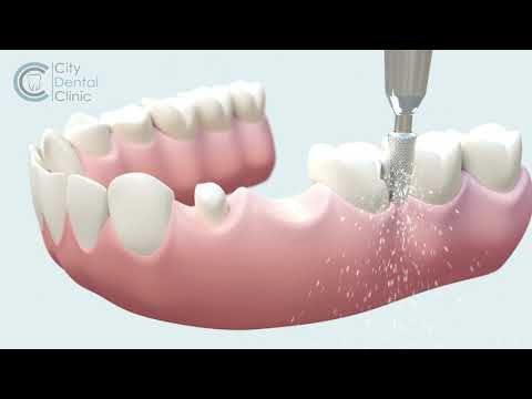Zahnbrücke Behandlungsablauf Animation