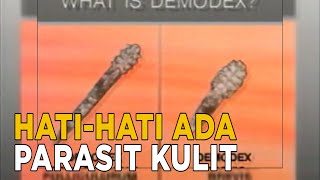 Download lagu Demodex adalah parasit yang bersalan di bawah kulit | JELANG SIANG mp3 Download lagu Demodex adalah parasit yang bersalan di bawah kulit | JELANG SIANG mp3