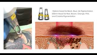 ND YAG Laser Q Switched Laser Tattoo Removal Machine youtube video