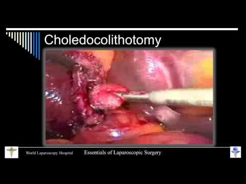Guidelines for Surgical Treatment of Laparoscopic CBD Exploration