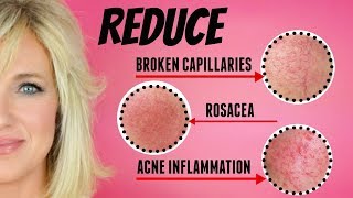 REDUCE Facial Redness, Broken Capillaries, Rosacea & Acne Inflammation!