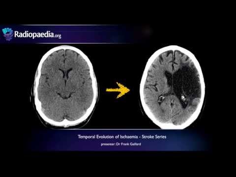 Stroke: Evolution from acute to chronic infarction - radiology video tutorial (CT, MRI)