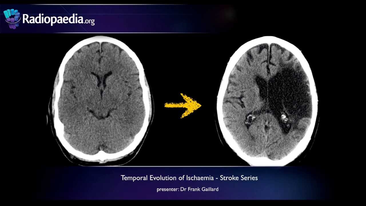 Stroke: Evolution from acute to chronic infarction - radiology video tutorial (CT, MRI)