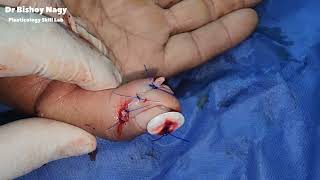Jersey Finger