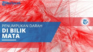 Hifema, Adanya Pengumpulan Darah di Ruang antara Kornea dan Iris