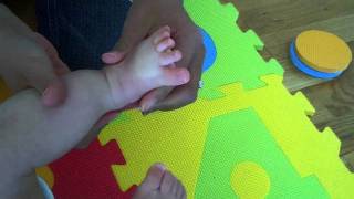 Prolonged capillary refill time in a completely well infant