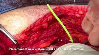 Core Videos (2024): Iatrogenic Bladder Trauma and Repair