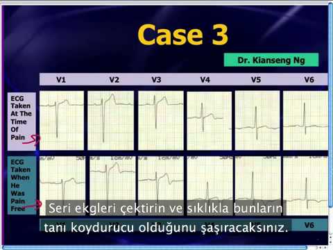 Mattu EKG Vakası: Wellens EKG Örnekleri - 19 Ağustos 2013