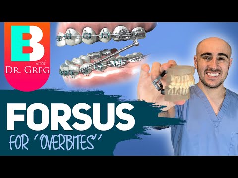 Braces Forsus for Overbite (Overjet) Correction