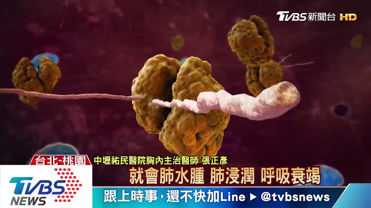 肺炎病毒vs.愛滋病毒異同 「免疫風暴」的致命危機