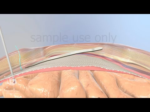Abdominal hernia surgery | ventral hernia 3d medical animation | sample use only