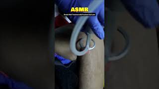 How to removal Stretch mark with fractional CO2 laser #shorts #shortvideo #youtubeshorts #youtube