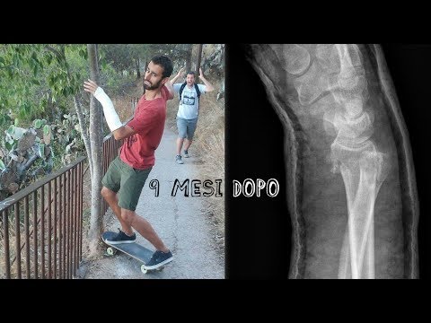 Trattamento dei costi ernia spinale Gli effetti delle operazioni sullarticolazione del ginocchio