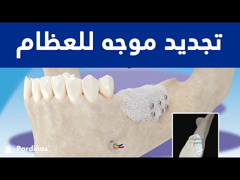 تجديد موجه للعظام ©