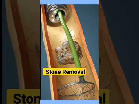 3D Key Hole Stone Removal | #kidneystone #kidneystonetreatment #3danimation #shorts #ytshorts #stone