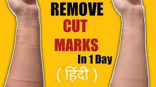 How To Remove Cut Marks From Hand Naturally | Remove Scars From Hand | Aditya Shubham