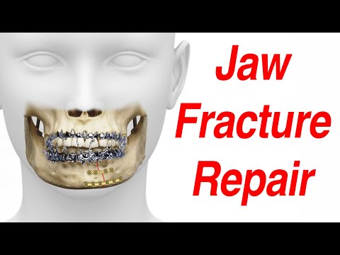 Jaw Fracture Surgical Treatment Animation (MMF - ORIF)