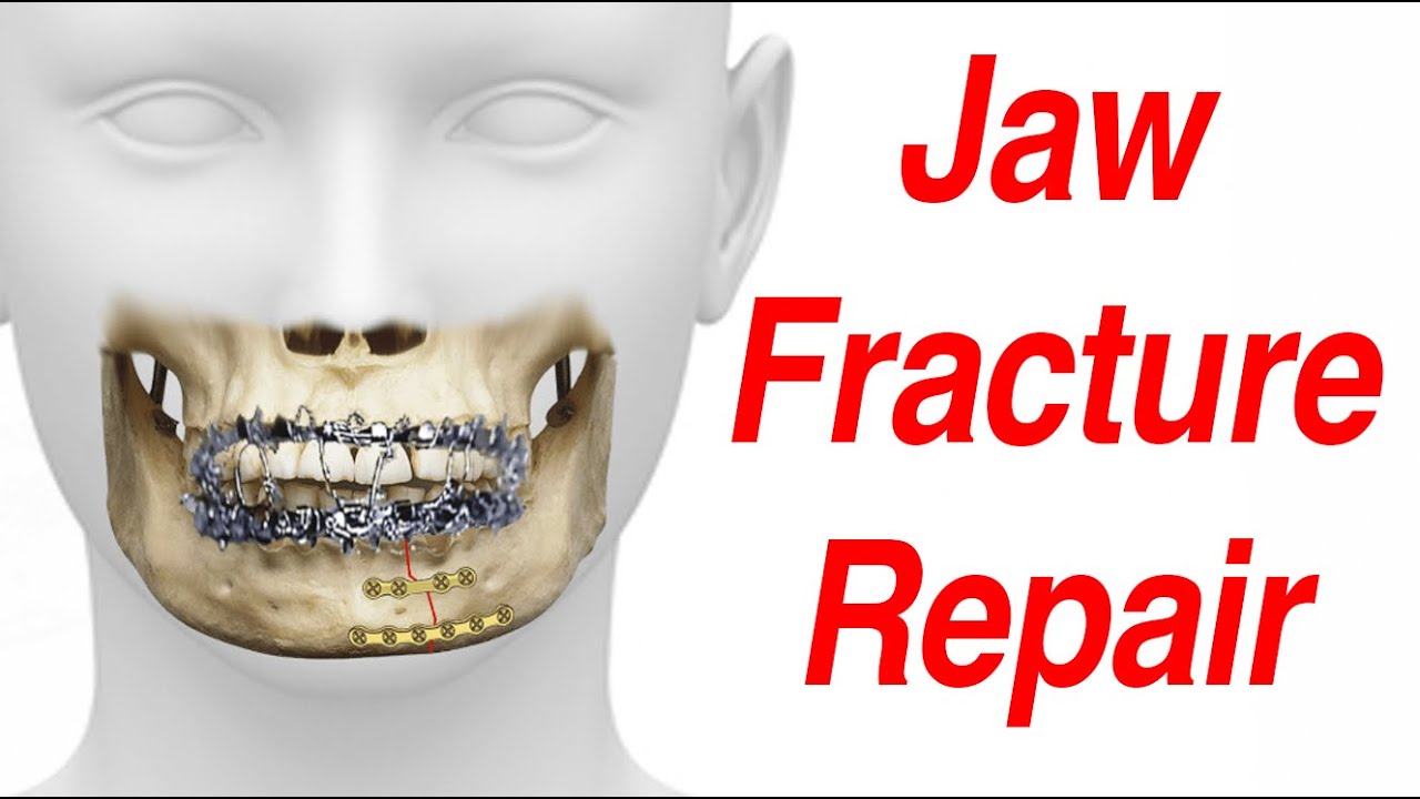 What is mandibular fracture fixation? Tipseri
