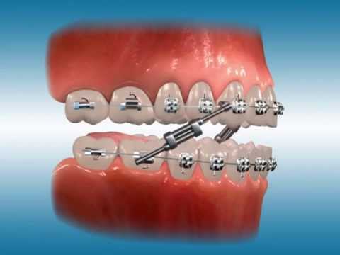 Twin Force® Bite Corrector for Class III Correction