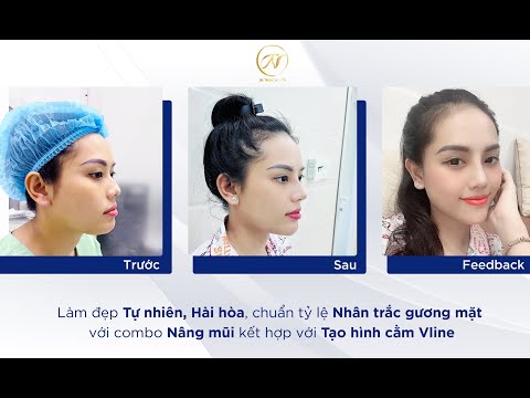 Nâng mũi không sưng đau tại Dr Trung Nguyễn có thật không?