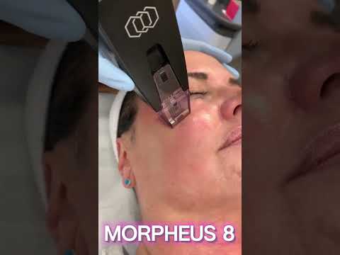 TIGHTEN & FIRM YOUR FACE AND NECK WITH MORPHEUS 8! #morpheus #morpheus8 #viralvideo