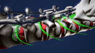 Miraculous Neurosurgical Procedure at Carolinas HealthCare System