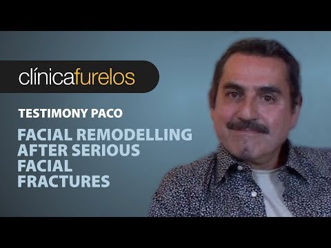 Paco. Facial remodelling after serious facial fractures (LOC)