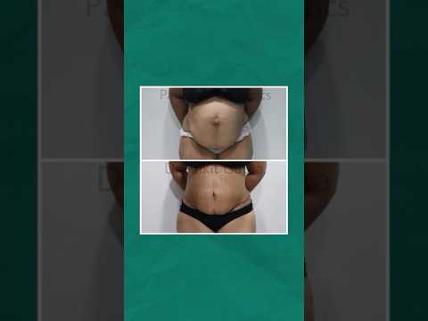 Tummy Tuck Patient Review