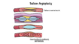 Lower Limb Angioplasty