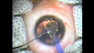 preview picture of video 'IPCL- IMPLANTABLE PHAKIC CONTACT LENS-Suruchi Eye Centre'