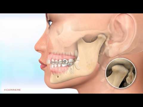 Carriere Class II distalization