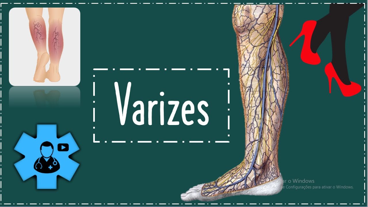 VARIZES ( Doença Venosa Crônica)