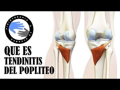 Tendinitis poplitea, que es y porque se produce el dolor detras de la rodilla