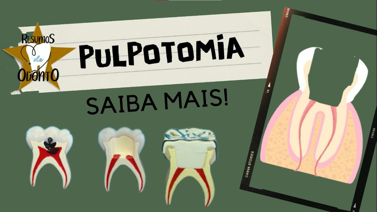 REMOÇÃO DA PORÇÃO CORONÁRIA : PULPOTOMIA | Resumos de Odonto