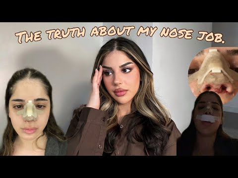 The truth about my nose job.