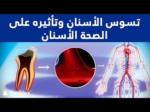 تسوس الأسنان وتأثيره على الصحة ©