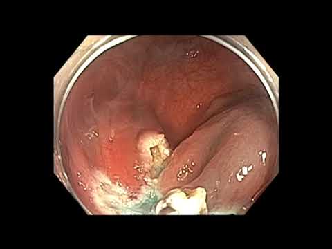 Coloscopie: Cæcum - LST non granulaire, résection muqueuse endoscopique