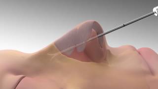 LATERA Animation for Patients with Nasal Congestion