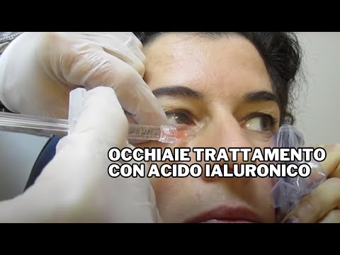 Quali maschere fare per la persona se la pelle molto secca I primi giorni dopo sollevamento di faccia