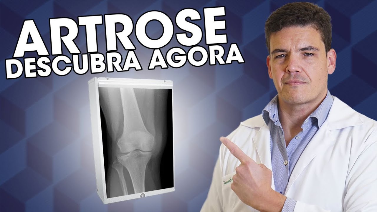 Qual o grau da minha artrose de joelho? Descubra neste vídeo!